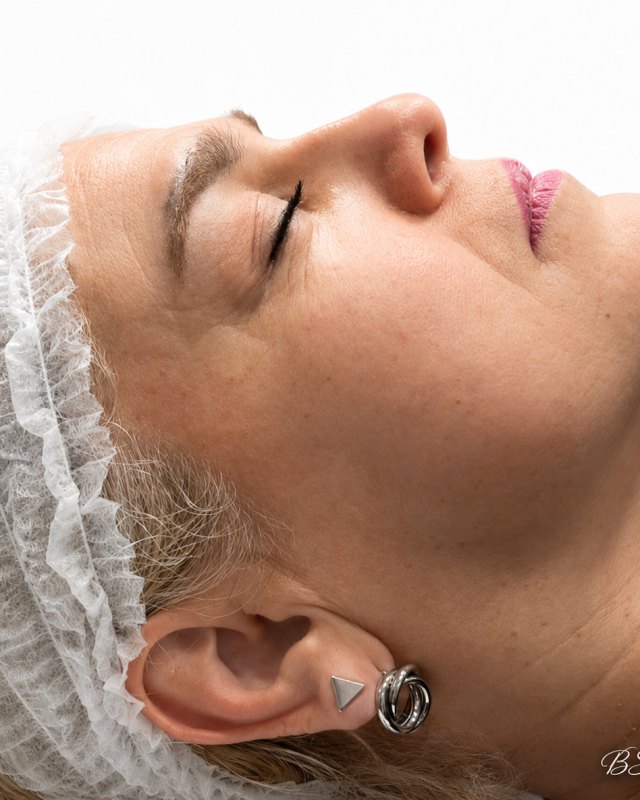 Antes de tratamiento de hidratación y volumen facial